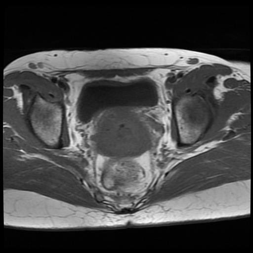 File:Cervical cancer (Radiopaedia 62991-71413 Axial T1 11).jpg