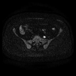 File:Cervical carcinoma (Radiopaedia 67644-77047 Axial DWI 5).jpg