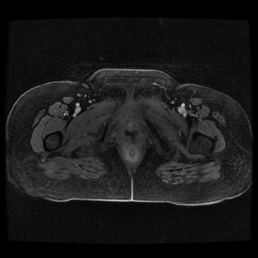 Cervical carcinoma (Radiopaedia 70924-81132 Axial T1 C+ fat sat 197).jpg
