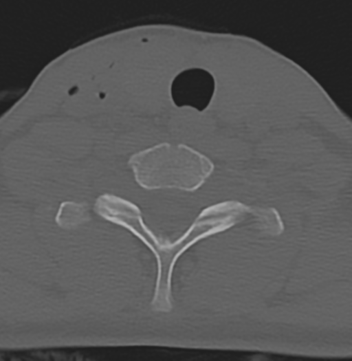 File:Cervical disc replacement (Radiopaedia 37383-39205 Axial bone window 15).png