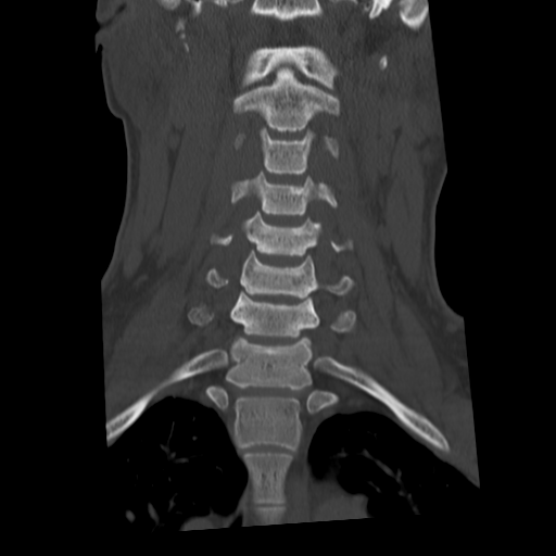 Cervical schwannoma (Radiopaedia 57979-64974 Coronal bone window 26).png