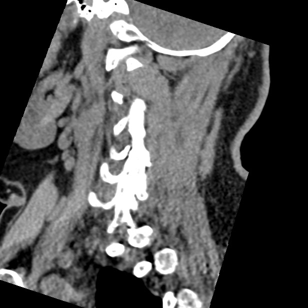 Cervical spinal neurofibroma in a patient with NF1 (Radiopaedia 58344-65464 C 40).jpg
