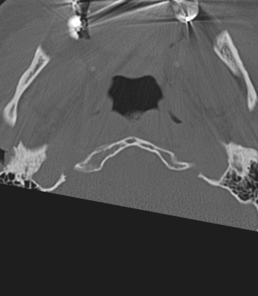 Cervical spine fractures with vertebral artery dissection (Radiopaedia 53296-59268 Axial bone window 5).png