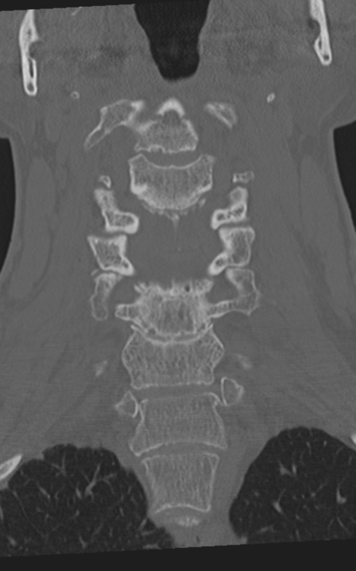 Cervical spine fractures with vertebral artery dissection (Radiopaedia 53296-59268 Coronal bone window 27).png