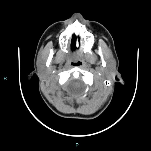 File:Cervical thymic cyst (Radiopaedia 88632-105335 Axial non-contrast 97).jpg