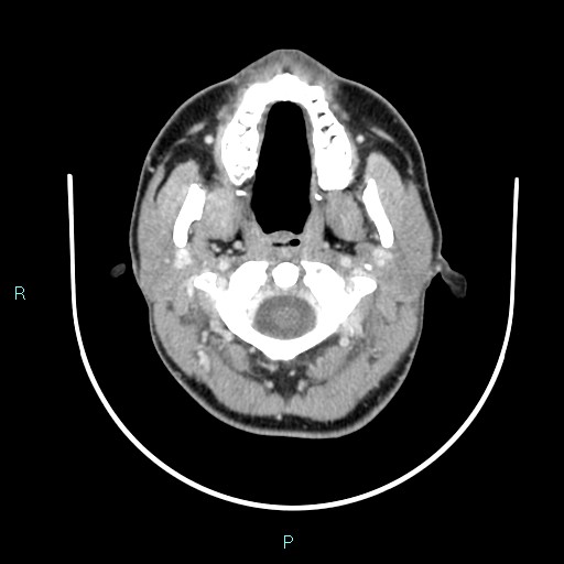 Cervical thymic cyst (Radiopaedia 88632-105335 C 94).jpg