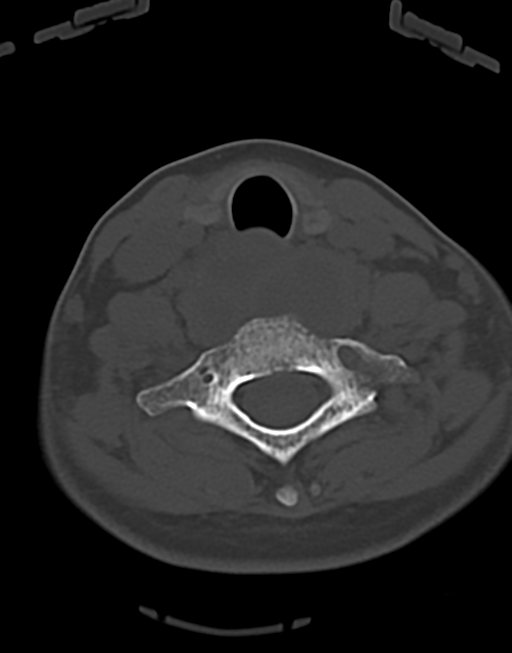 Cervical tuberculous spondylitis (Radiopaedia 39149-41365 Axial bone window 40).png