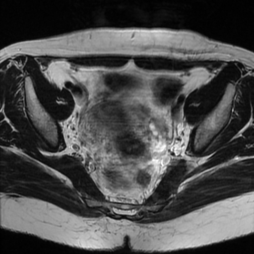 File:Cesarian section scar endometriosis (Radiopaedia 66520-75799 Axial T2 10).jpg