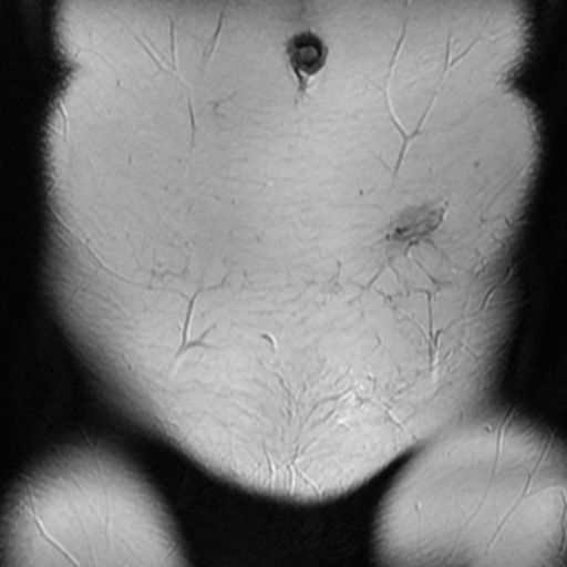 File:Cesarian section scar endometriosis (Radiopaedia 66520-75799 Coronal T2 2).jpg