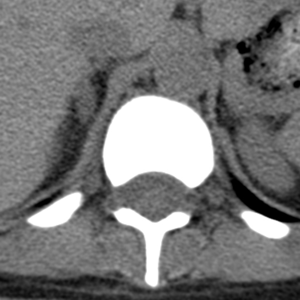 File:Chance fracture (Radiopaedia 36521-38081 Axial non-contrast 57).jpg