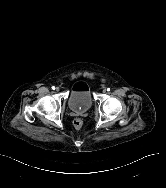 Cholangiocarcinoma with cerebral metastases (Radiopaedia 83519-98629 B 119).jpg