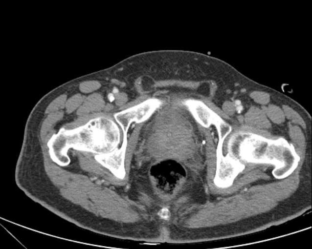 File:Cholecystitis - perforated gallbladder (Radiopaedia 57038-63916 A 80).jpg