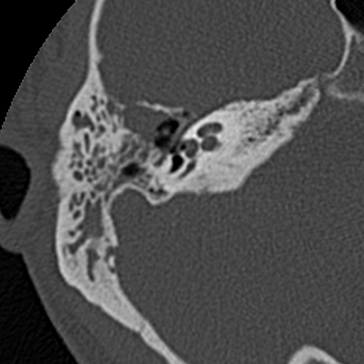 File:Cholesteatoma (Radiopaedia 15846-15494 bone window 13).jpg