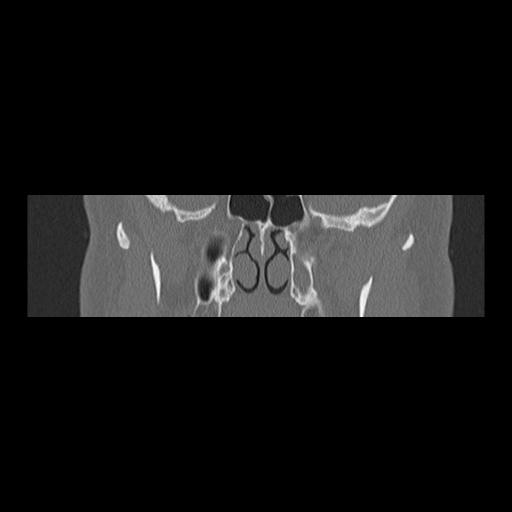 Cholesteatoma (Radiopaedia 84946-100455 Coronal bone window 62).jpg