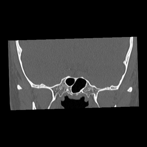 Cholesteatoma (Radiopaedia 84960-100474 Coronal bone window 7).jpg