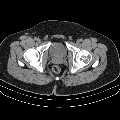 File:Chondroblastoma (Radiopaedia 12264-12563 Axial non-contrast 4).jpg