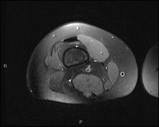 File:Chondroblastoma (Radiopaedia 62721-71031 Axial PD fat sat 3).jpg