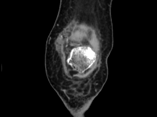 Chondrosarcoma - femur (Radiopaedia 64187-72954 C 8).jpg