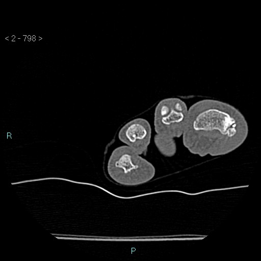 Chondrosarcoma - phalanx (Radiopaedia 69047-78812 Axial bone window 52).jpg