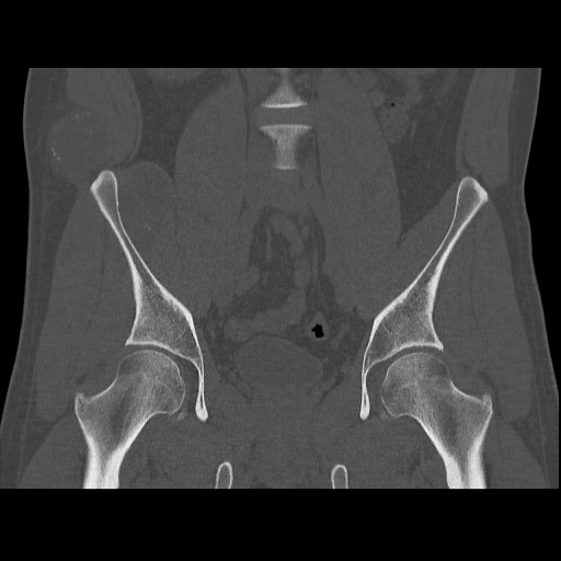 Chondrosarcoma of iliac wing (Radiopaedia 63861-72599 Coronal bone window 57).jpg