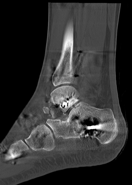 Chopart fracture (Radiopaedia 35347-36861 Sagittal bone window 49).jpg