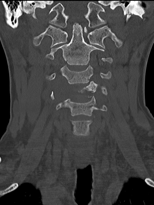 Chordoma (C4 vertebra) (Radiopaedia 47561-52188 Coronal bone window 16).png
