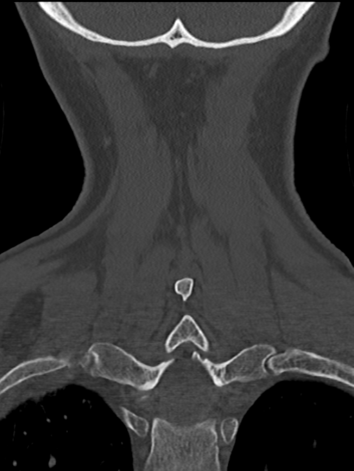 Chordoma (C4 vertebra) (Radiopaedia 47561-52188 Coronal bone window 50).png