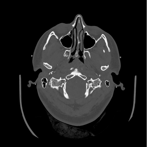 Choroid plexus papilloma extending into the cerebellopontine angle cistern (Radiopaedia 85941-101833 Axial bone window 19).png