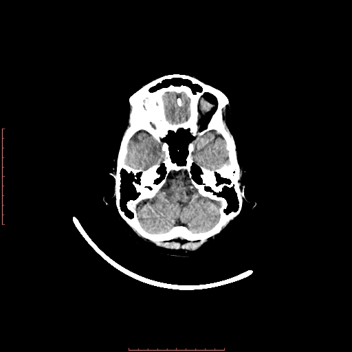 File:Choroid plexus xanthogranuloma (Radiopaedia 67843-77269 Axial non-contrast 12).jpg
