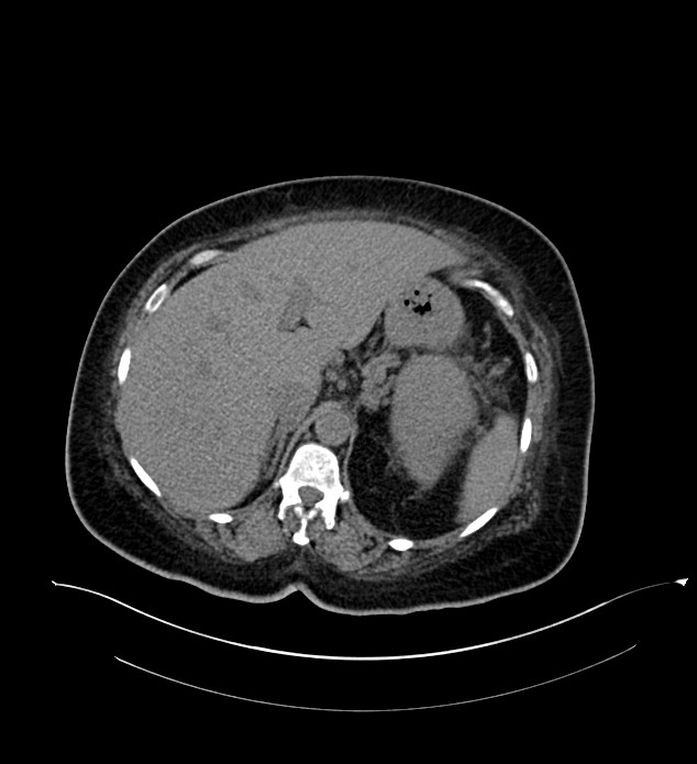 Chromophobe renal cell carcinoma (Radiopaedia 84239-99519 Axial non-contrast 50).jpg