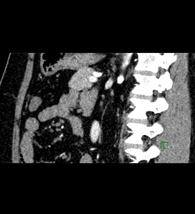 Chromophobe renal cell carcinoma (Radiopaedia 84286-99573 F 71).jpg