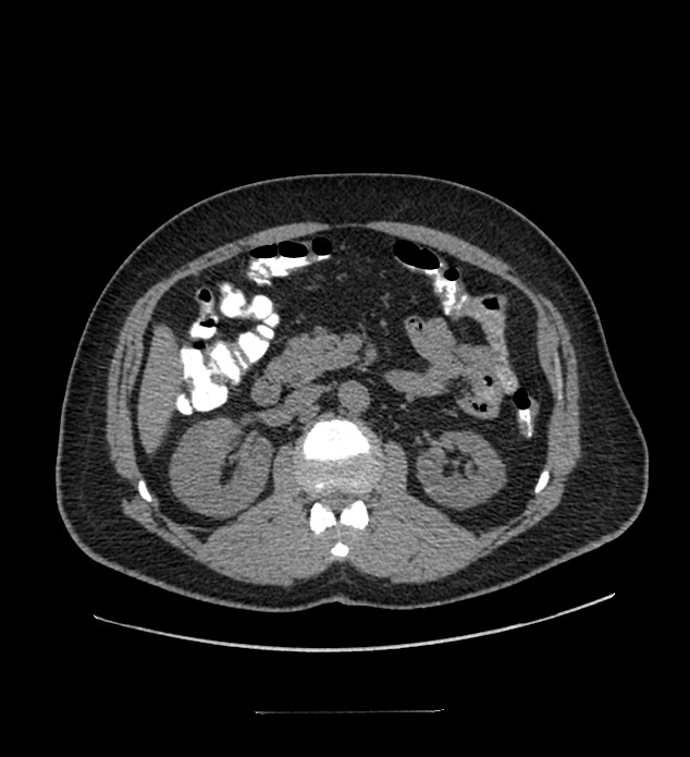 Chromophobe renal cell carcinoma (Radiopaedia 84337-99644 Axial non-contrast 41).jpg