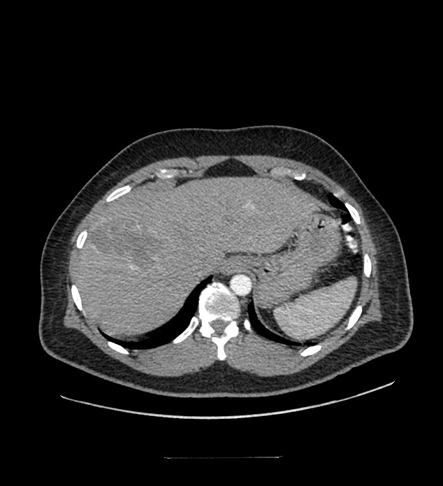 Chromophobe renal cell carcinoma (Radiopaedia 84337-99644 B 12).jpg
