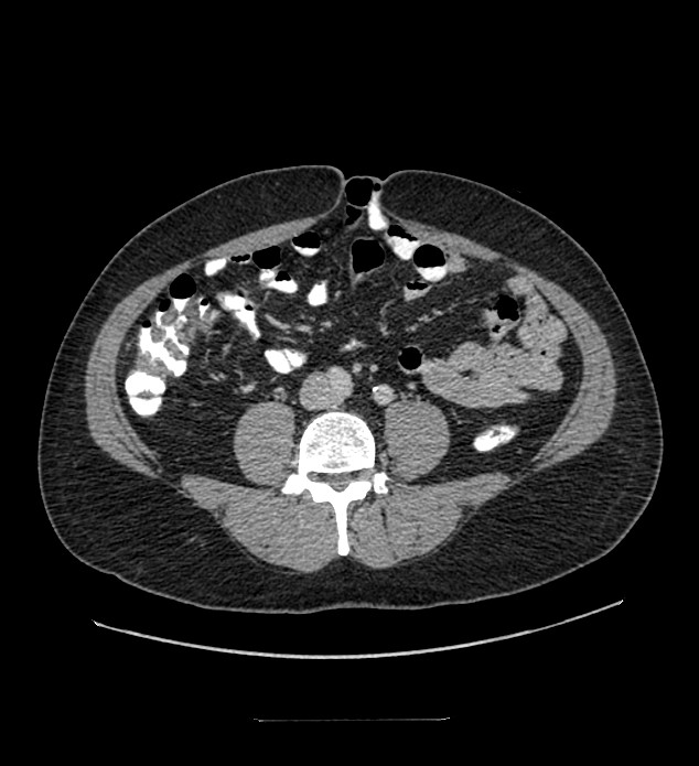 Chromophobe renal cell carcinoma (Radiopaedia 84337-99644 C 81).jpg