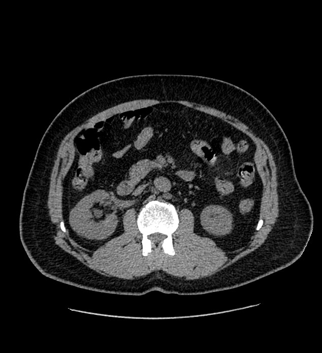 Chromophobe renal cell carcinoma (Radiopaedia 84337-99693 Axial non-contrast 58).jpg