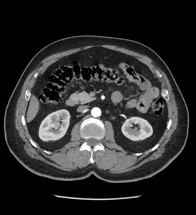 Chromophobe renal cell carcinoma (Radiopaedia 86879-103083 B 59).jpg