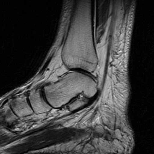File:Chronic Achilles tendon rupture (Radiopaedia 15262-15100 Sagittal T2 10).jpg