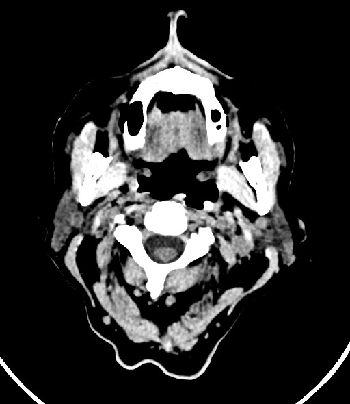 Chronic bilateral subdural hygroma (Radiopaedia 85801-101623 Axial non-contrast 64).jpg