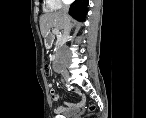 Chronic contained rupture of abdominal aortic aneurysm with extensive erosion of the vertebral bodies (Radiopaedia 55450-61901 B 18).jpg