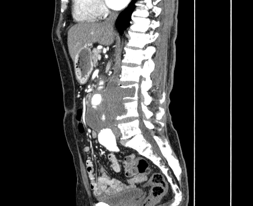 Chronic contained rupture of abdominal aortic aneurysm with extensive erosion of the vertebral bodies (Radiopaedia 55450-61901 B 26).jpg