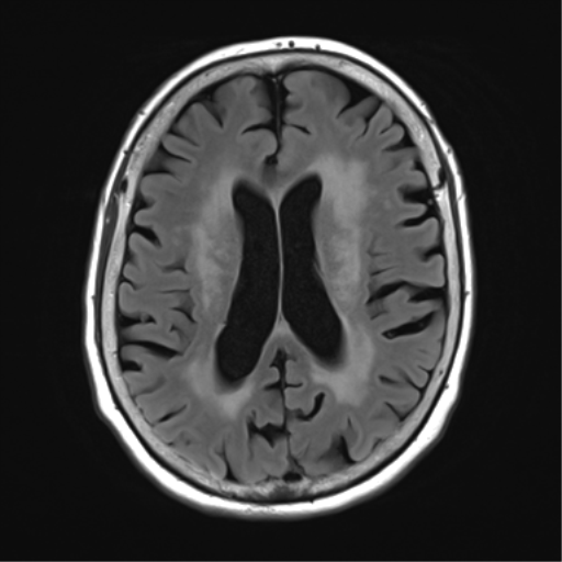 File:Chronic hypertensive encephalopathy (Radiopaedia 39993-42482 Axial FLAIR 17).png