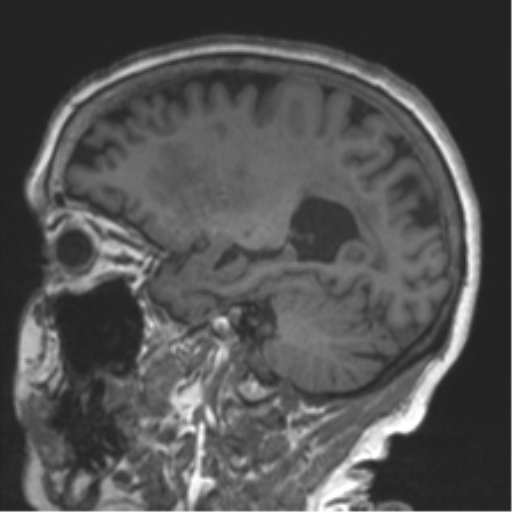Chronic hypertensive encephalopathy (Radiopaedia 39993-42482 Sagittal T1 35).png
