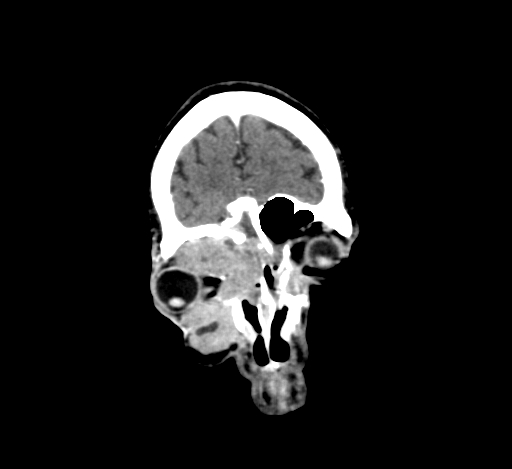 Chronic invasive fungal sinusitis with intraorbital and intracranial extension (Radiopaedia 56387-63046 C 61).jpg