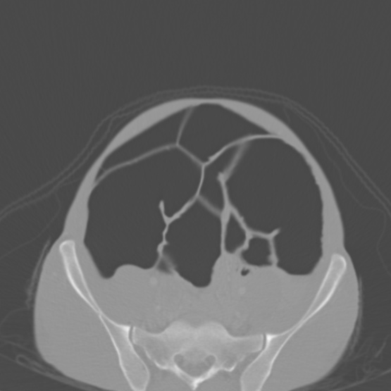 Chronic large bowel pseudo-obstruction (Radiopaedia 43181-46492 Axial bone window 130).jpg