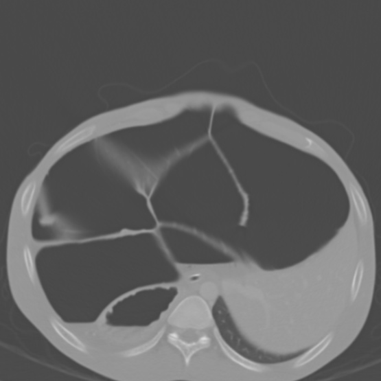 Chronic large bowel pseudo-obstruction (Radiopaedia 43181-46492 Axial bone window 45).jpg