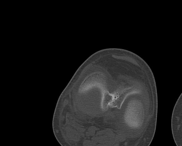Chronic ostemyelitis of the femur with long sinus tract (Radiopaedia 74947-85982 Axial bone window 230).jpg