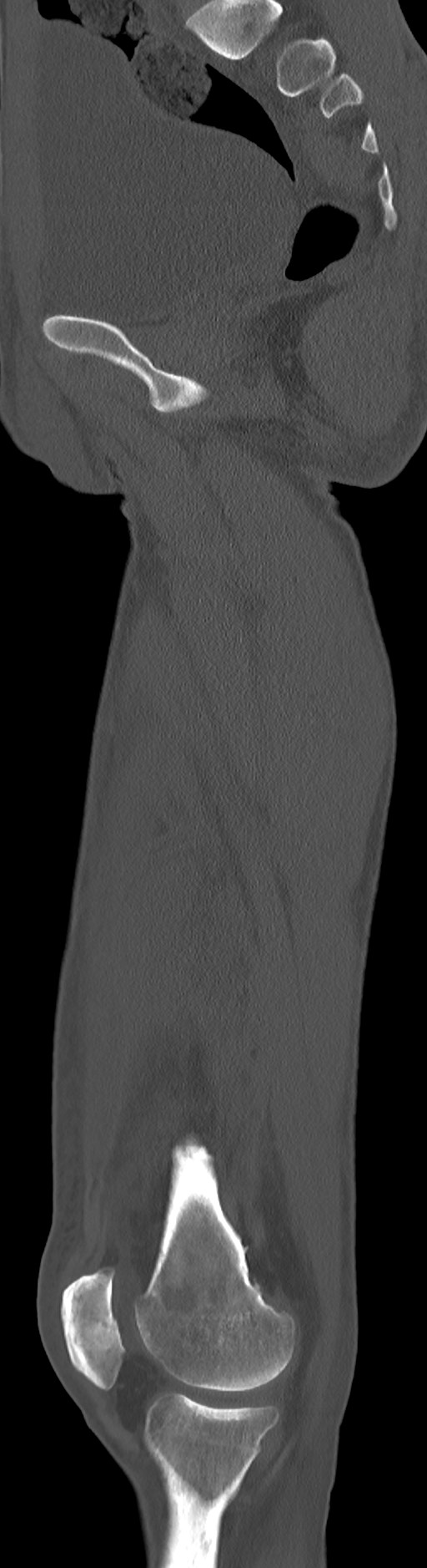 Chronic osteomyelitis (with sequestrum) (Radiopaedia 74813-85822 C 64).jpg