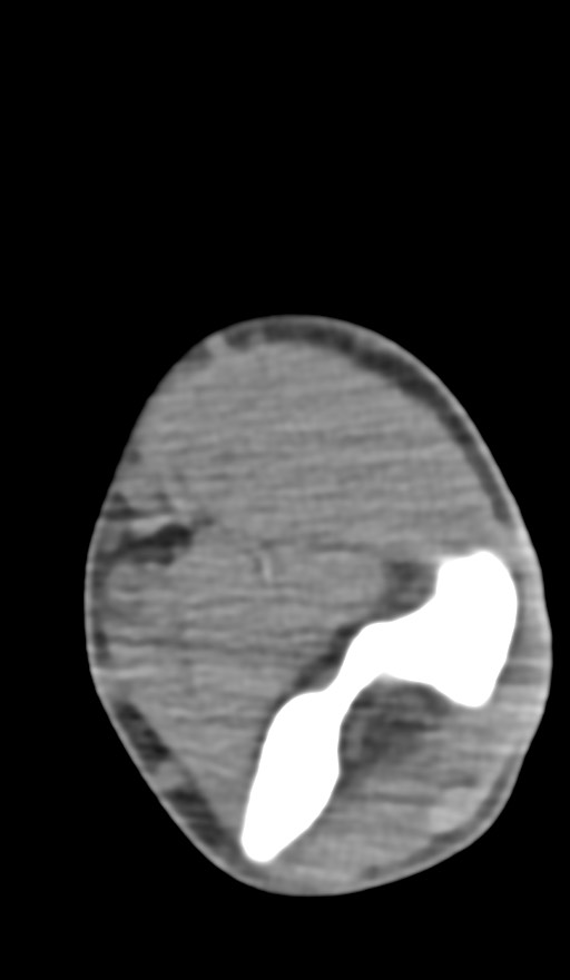 Chronic osteomyelitis of the distal humerus (Radiopaedia 78351-90971 Axial non-contrast 88).jpg