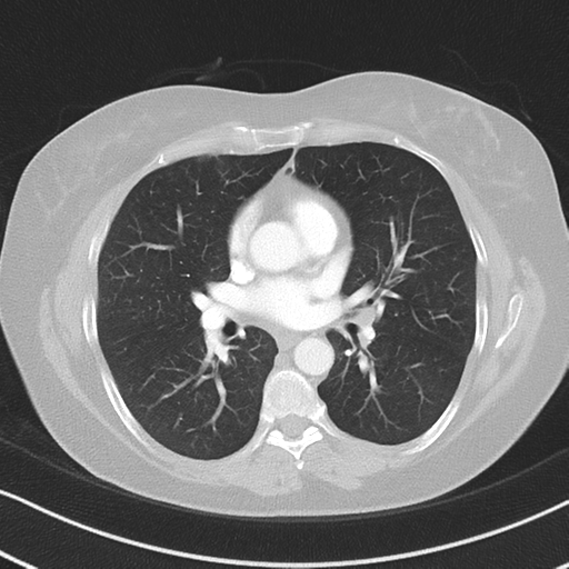 Chronic pulmonary embolus (Radiopaedia 39129-41341 Axial lung window 33).png
