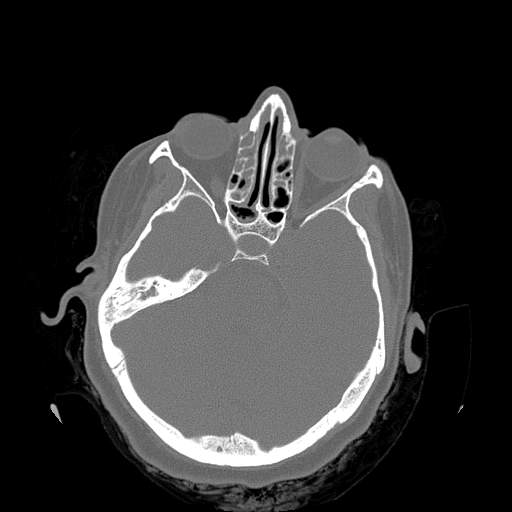 Chronic sinusitis with intra-sinus calcification (Radiopaedia 63919-72668 Axial bone window 18).jpg